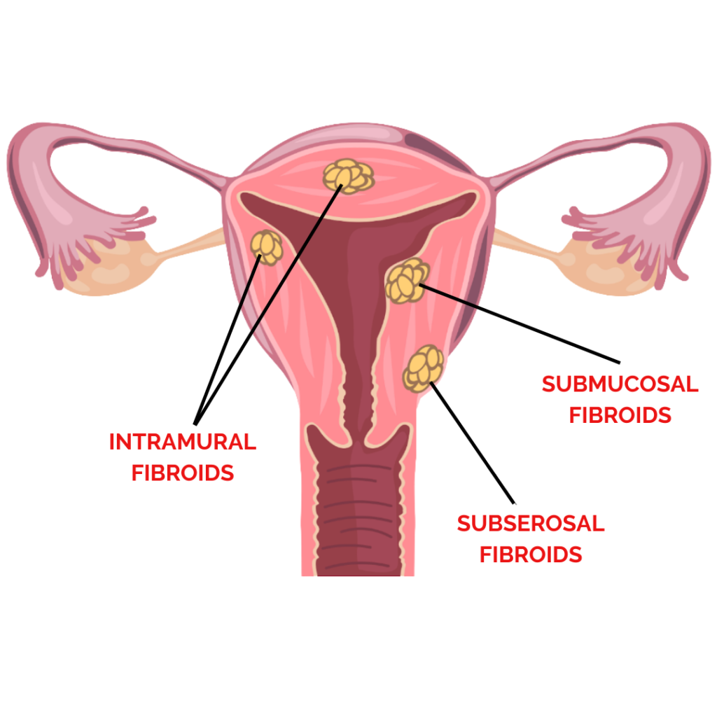 Subserosal Fibroids